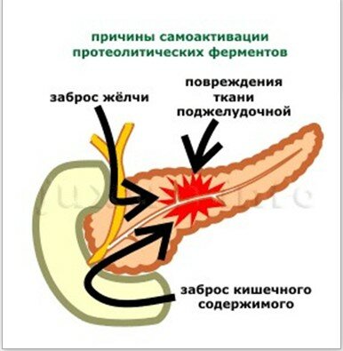 Активация ферментов поджелудочной железы. Острый билиарный панкреатит патогенез. Схема активации ферментов поджелудочной железы. Острый панкреатит схема. Патогенез острого панкреатита.